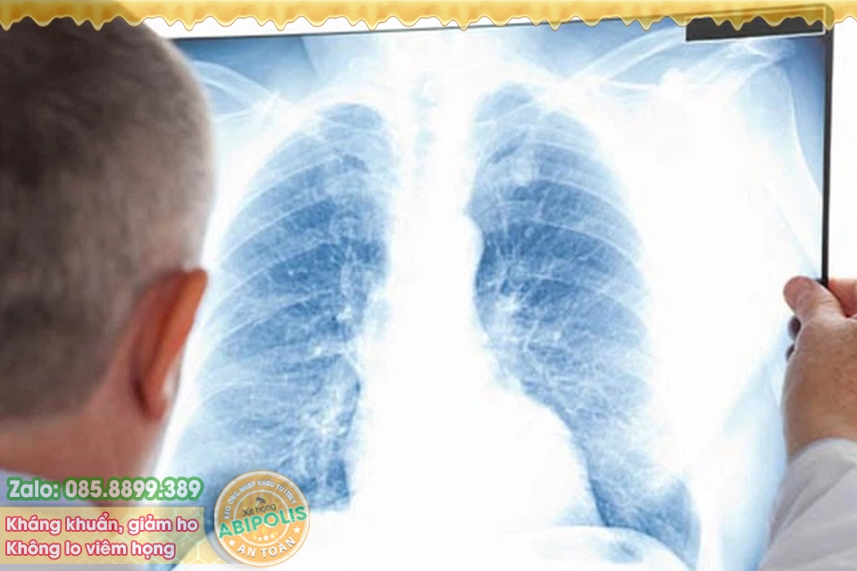 Nấm phổi do Aspergillus: Bệnh nguy hiểm nhưng ít người biết