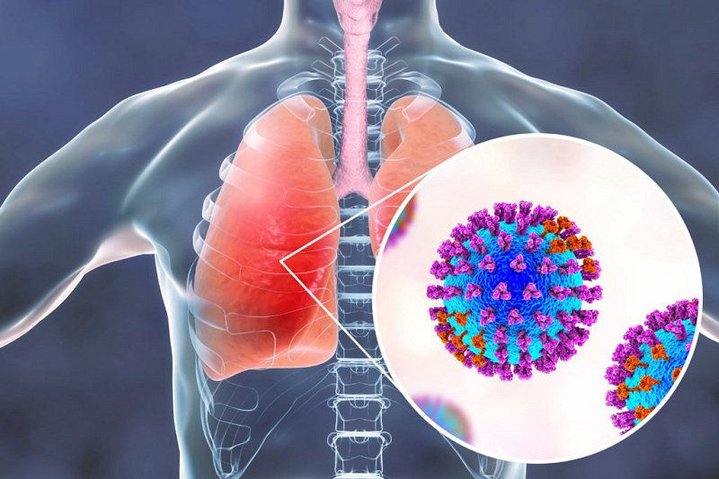 Khác biệt viêm phổi do COVID-19, triệu chứng và những điều cần biết
