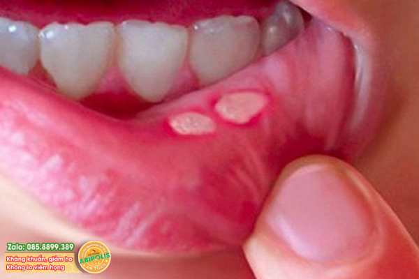 Nhiệt miệng là gì? Nguyên nhân, triệu chứng và cách điều trị tại nhà