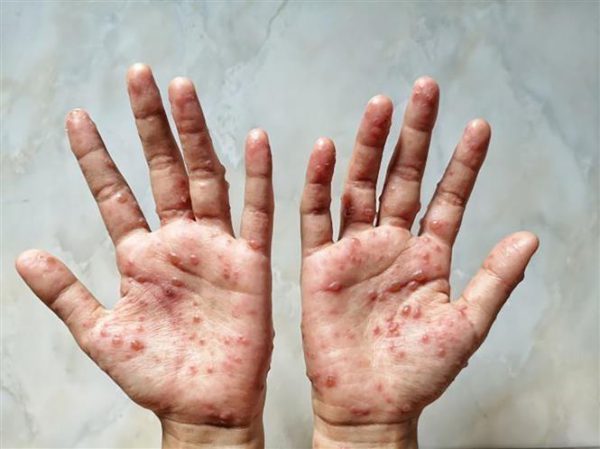 Phân biệt đậu mùa khỉ với thủy đậu, tay chân miệng, Herpes lan tỏa