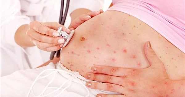 Mang thai mắc bệnh đậu mùa khỉ và những điều cần biết