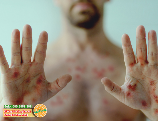 Bệnh đậu mùa khỉ lây qua đường nào? Biện pháp phòng ngừa nhiễm virus